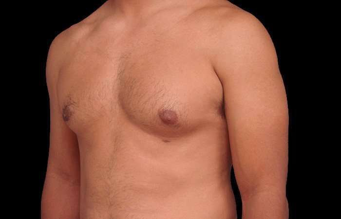Gynecomastia Before & After Patient #101