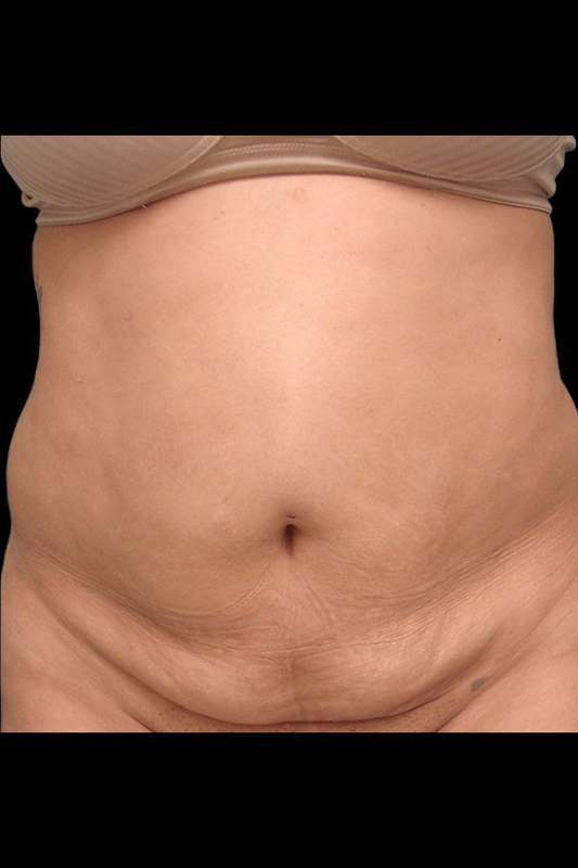 Tummy Tuck Before & After Patient #69