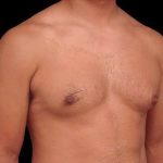 Gynecomastia Before & After Patient #101