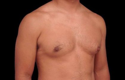 Gynecomastia Before & After Patient #101