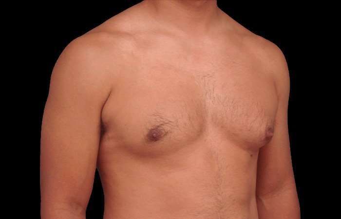 Gynecomastia Before & After Patient #101
