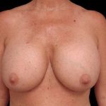 Breast Lift Before & After Patient #108