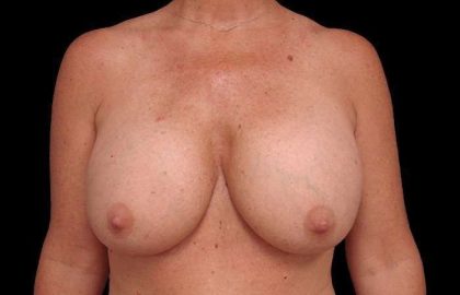Breast Lift Before & After Patient #108