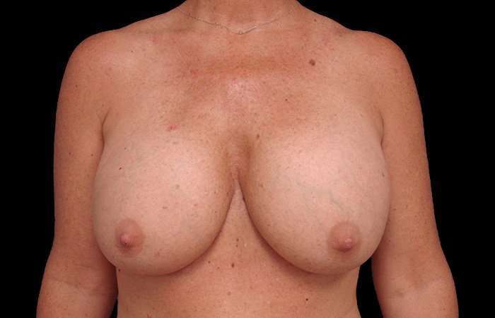 Breast Implant Removal Before & After Patient #108