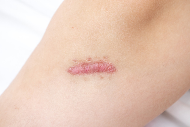 Keloid Treatment