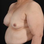 Breast Implant Exchange Before & After Patient #645