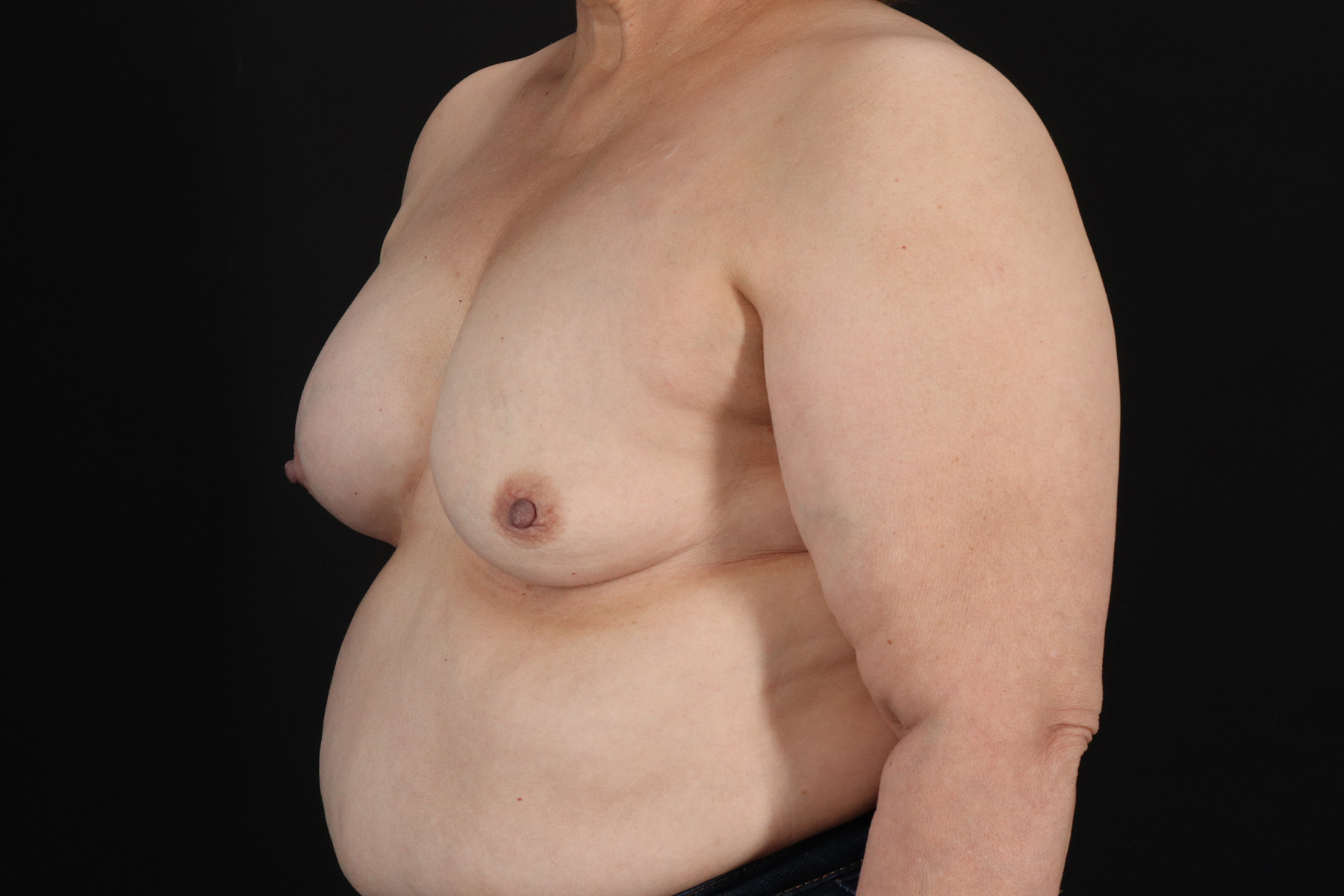 Breast Implant Exchange Before & After Patient #645