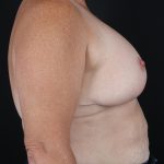 Breast Reduction with Lift Before & After Patient #644
