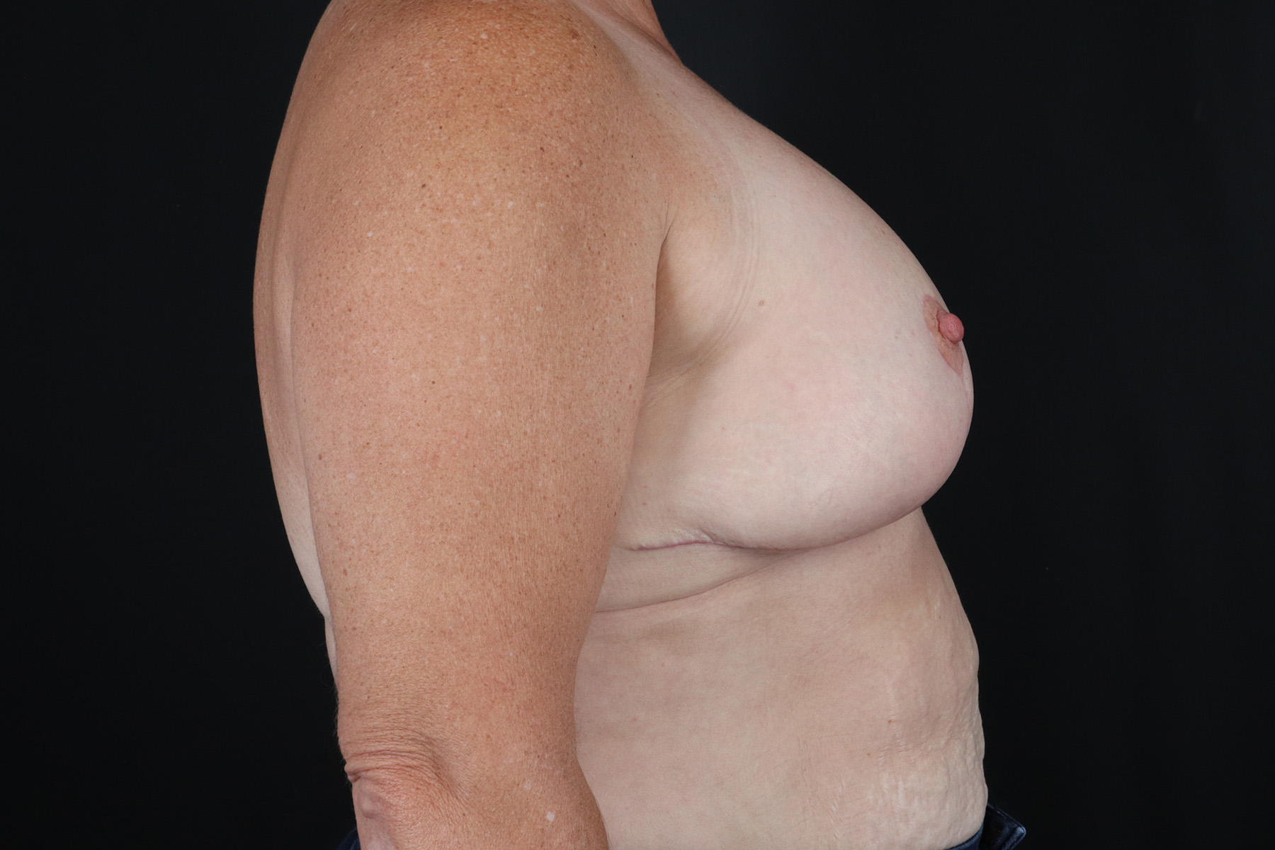 Breast Reduction with Lift Before & After Patient #644